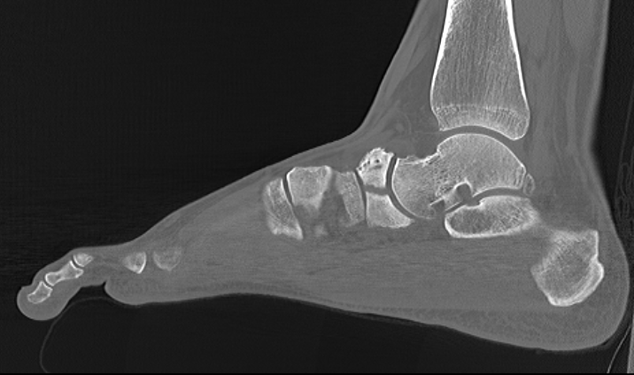 Navicular Fracture CT2